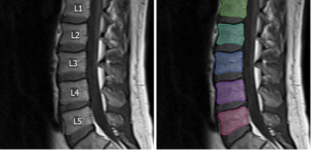 Visage AI Spine Labeling.jpg