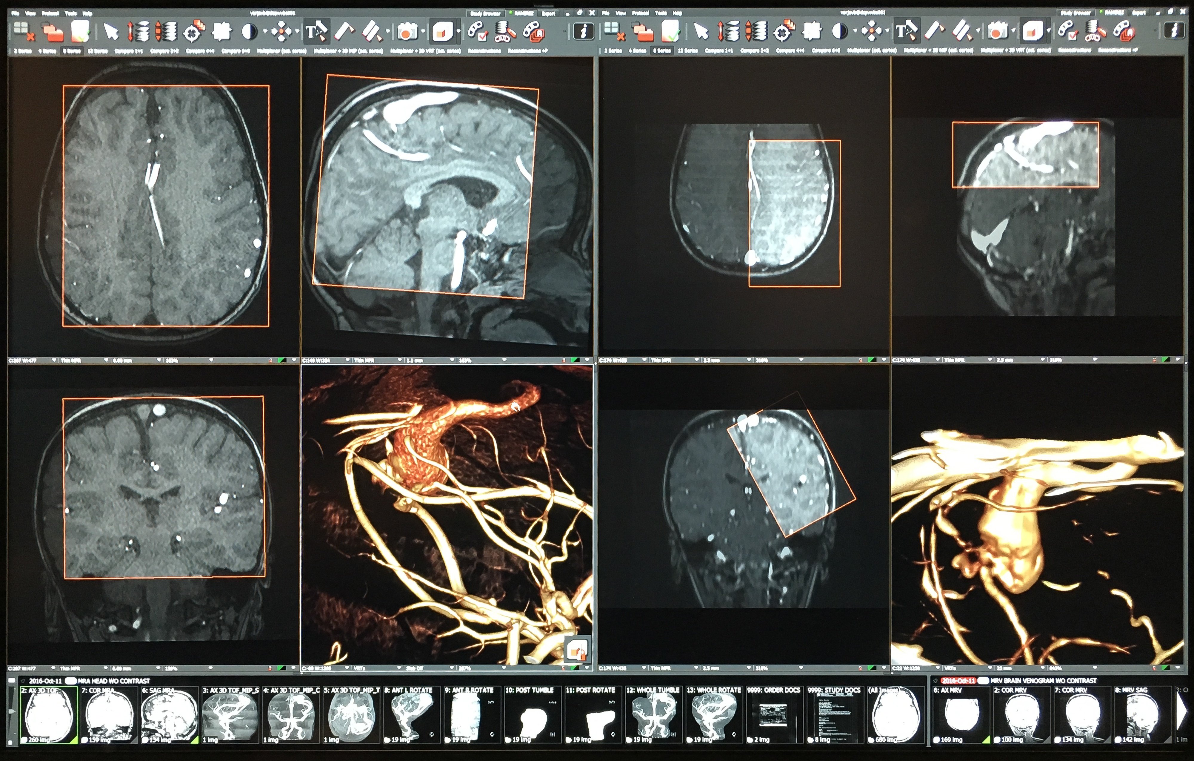 Real World Success Stories in Enterprise Imaging | Case #1: Pediatric Aneurysm